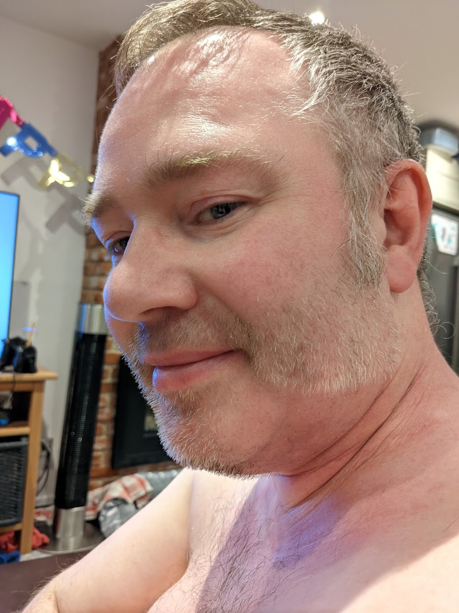 Radiotherapy hair loss